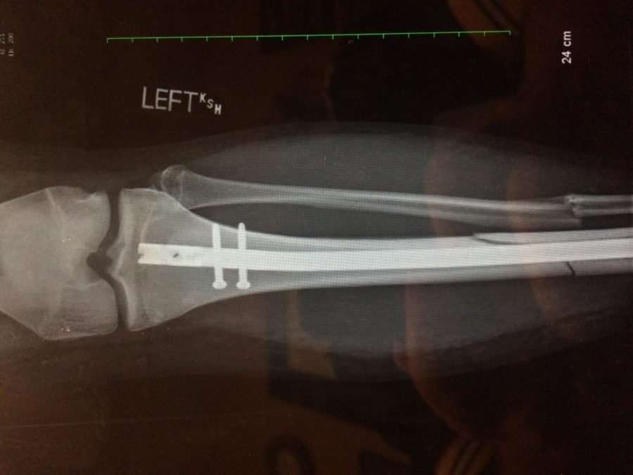 An x-ray shows the break to Tyler Brownings leg.